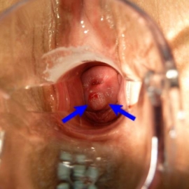 Плоскоклеточный рак T1aN0M0 на нижней губе шейки матки (стрелки)