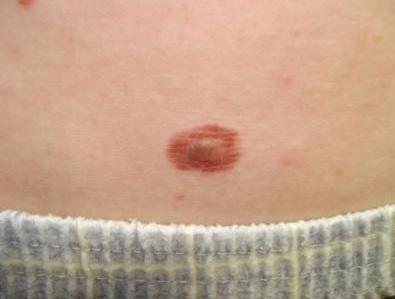 melanoma at an early stage of development.