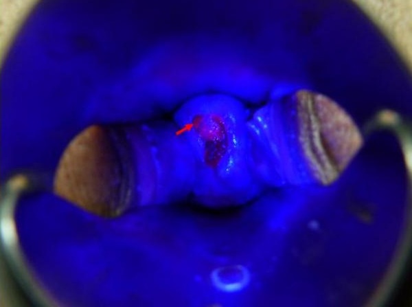 Fluorescent diagnostics of cervical carcinoma. In ultra-violet light after intra-venous infusion of dimegin. Pink luminescence reveals malignant lesions (marked by arrow).