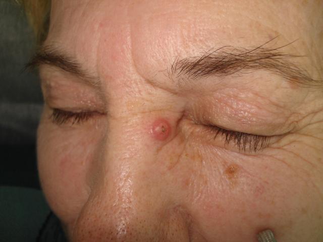 Exophytic squamous cell carcinoma of the nose skin (early stage).
