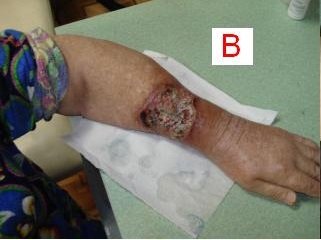 C. Granulating wound after the rejection of scab.