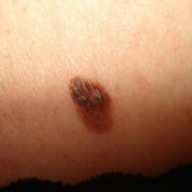 melanoma at an early stage of development.