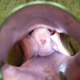 Cervix uteri affected by cancer in conventional colposcopy