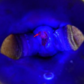 Fluorescent diagnostics of cervical carcinoma. In ultra-violet light after intra-venous infusion of dimegin. Pink luminescence reveals malignant lesions (marked by arrow).