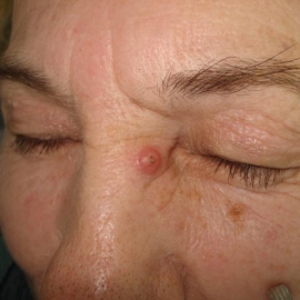Exophytic squamous cell carcinoma of the nose skin (early stage).