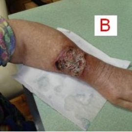 C. Granulating wound after the rejection of scab.