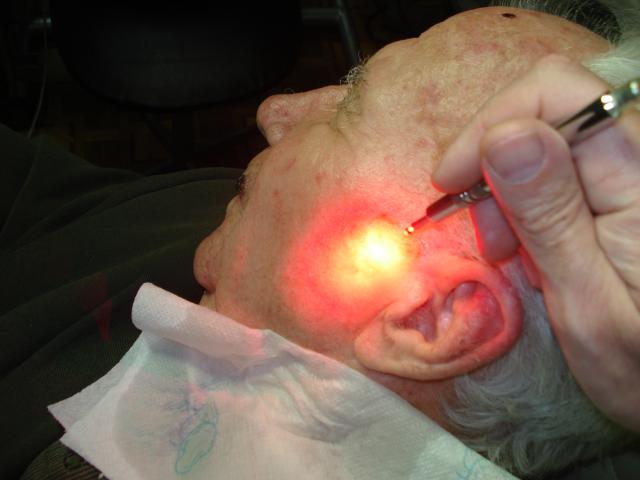 Б. Пациенту проводится сеанс фотодинамической терапии.