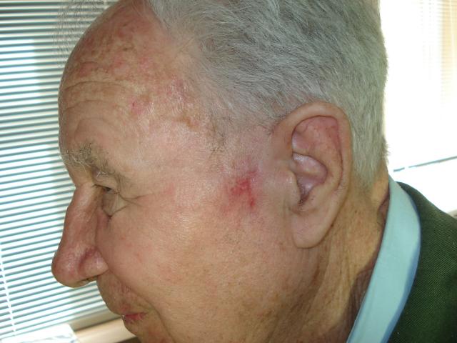 Г. Малозаметный эластичный рубец на месте проведения ФДТ, функция лицевого нерва не нарушена.