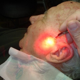 Б. Пациенту проводится сеанс фотодинамической терапии.
