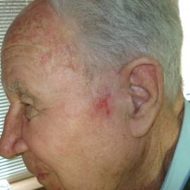 Г. Малозаметный эластичный рубец на месте проведения ФДТ, функция лицевого нерва не нарушена.
