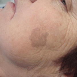 Меланома кожи, требующая дифференциальной диагностистики с себорейной кератомой (данный вид меланомы легко принять за возрастное пятно).